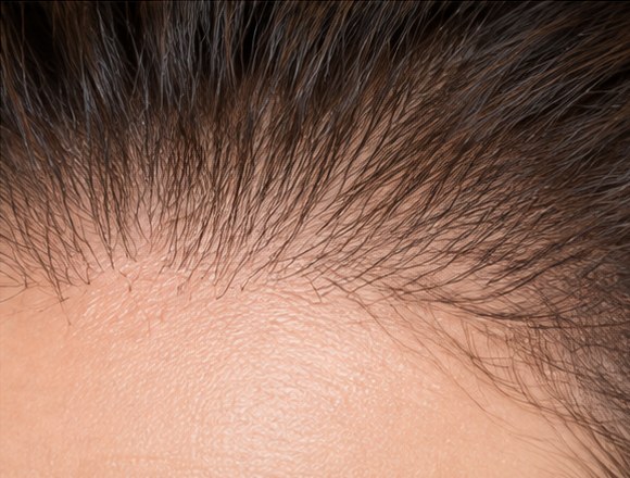 Angles d'implantation des cheveux, couchés vers l'avant et les tempes
