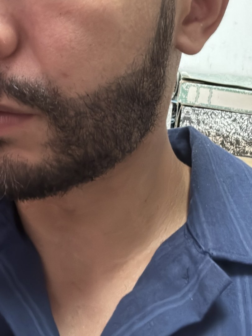 Après greffe de barbe