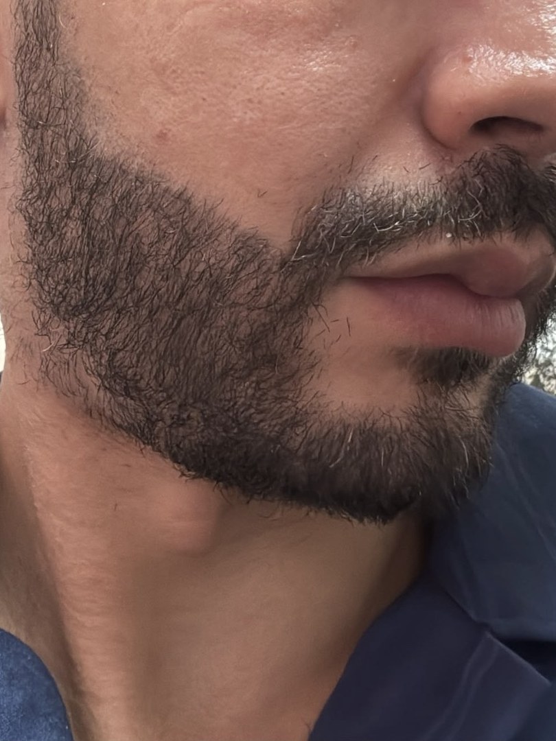 Après greffe de barbe