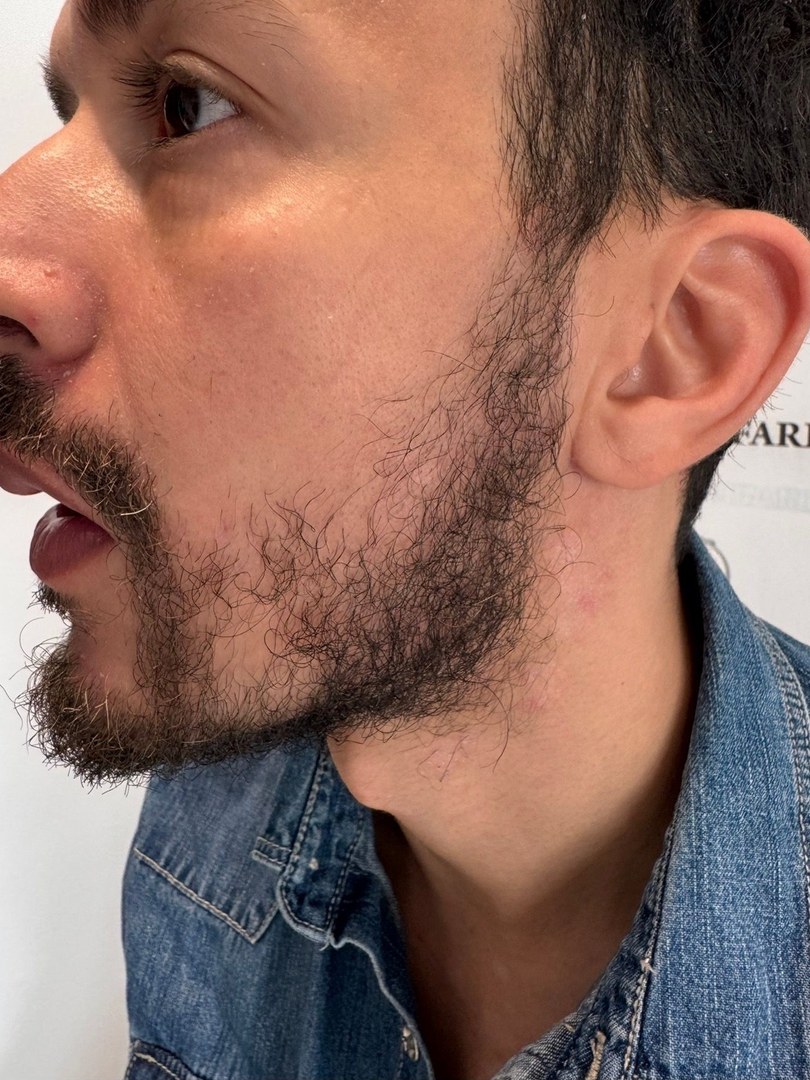 Avant greffe de barbe