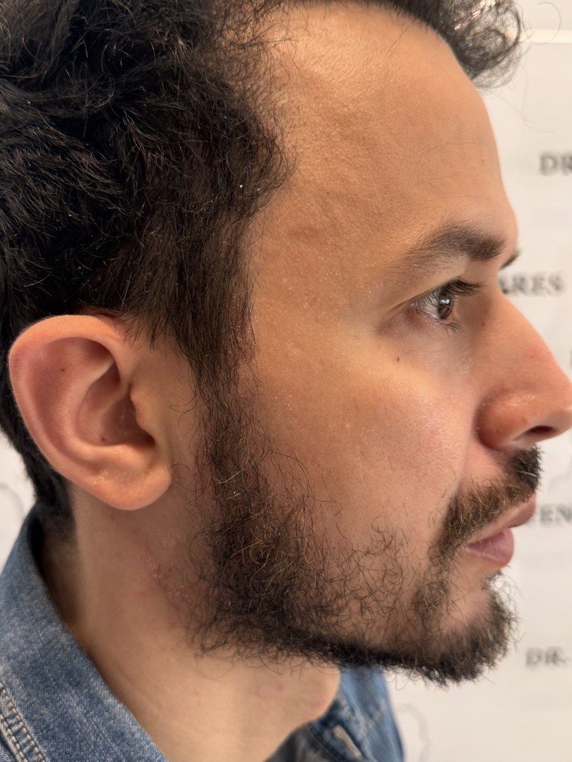 Avant greffe de barbe