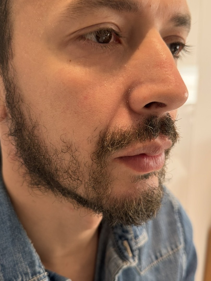 Avant greffe de barbe