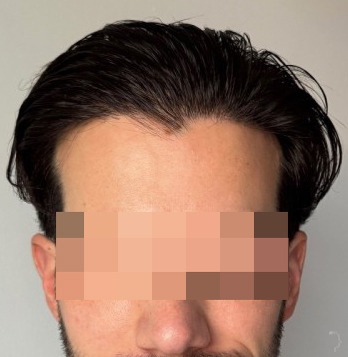 Patient 95, after hair transplant