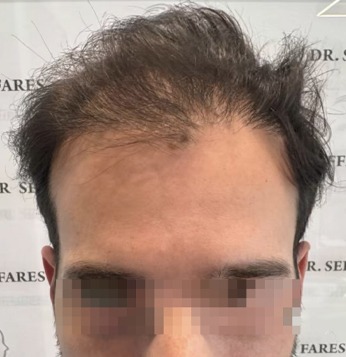 Patient 95, before hair transplant