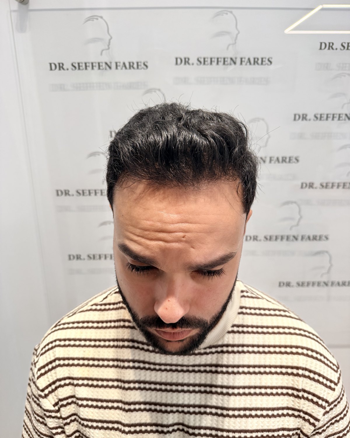 Patient 97 douze mois après la greffe de cheveux, de face