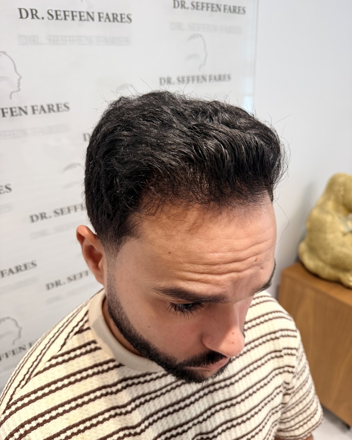 Patient 97 douze mois après la greffe de cheveux, de profil
