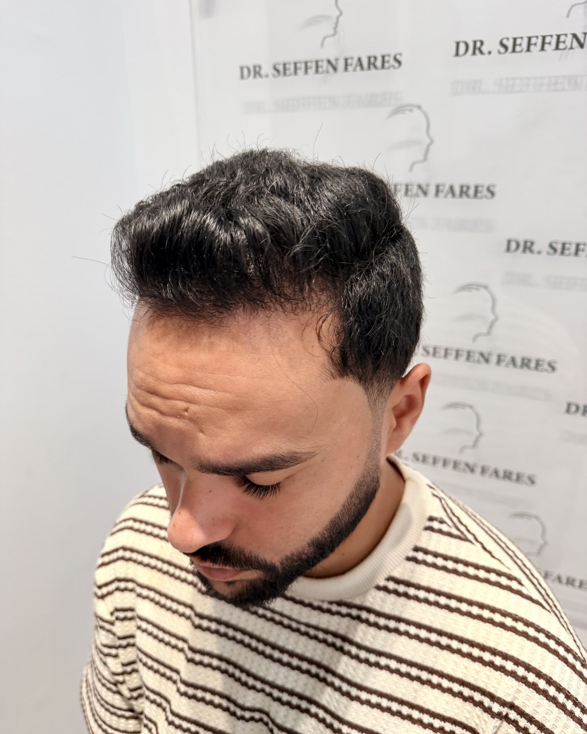 Patient 97 douze mois après la greffe de cheveux, ligne frontale