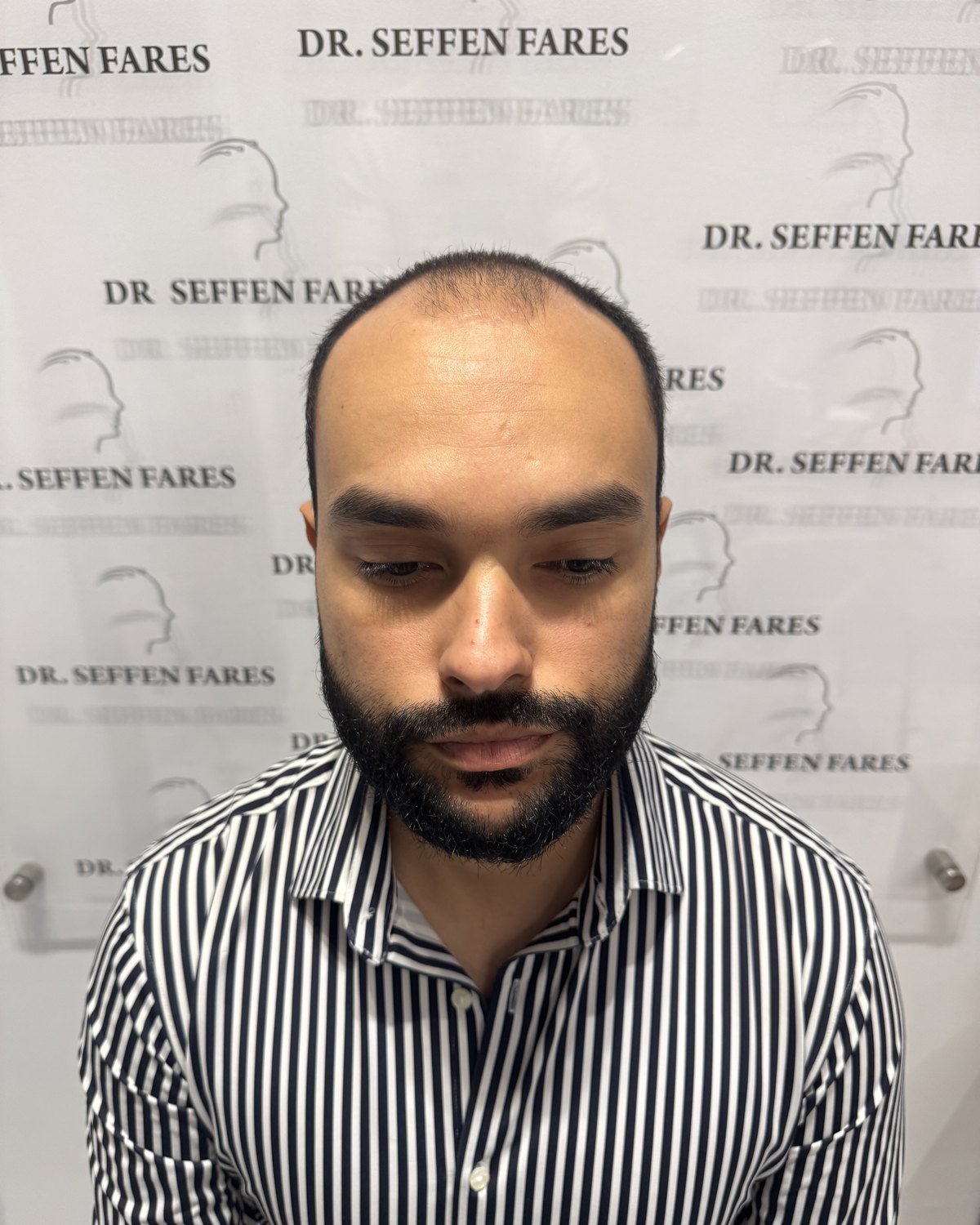 Patient 97 avant la greffe de cheveux, de face