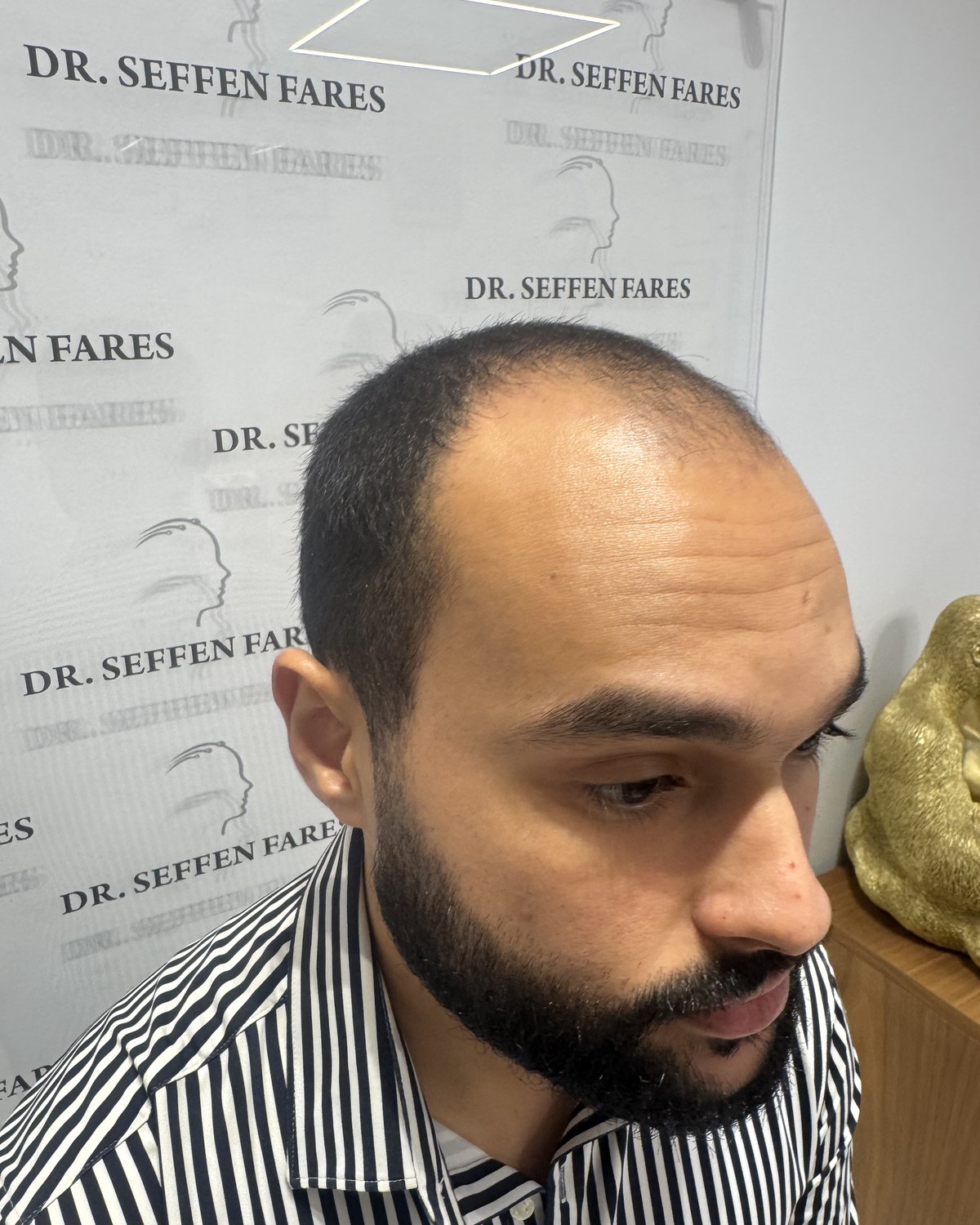 Patient 97 avant la greffe de cheveux, de profil