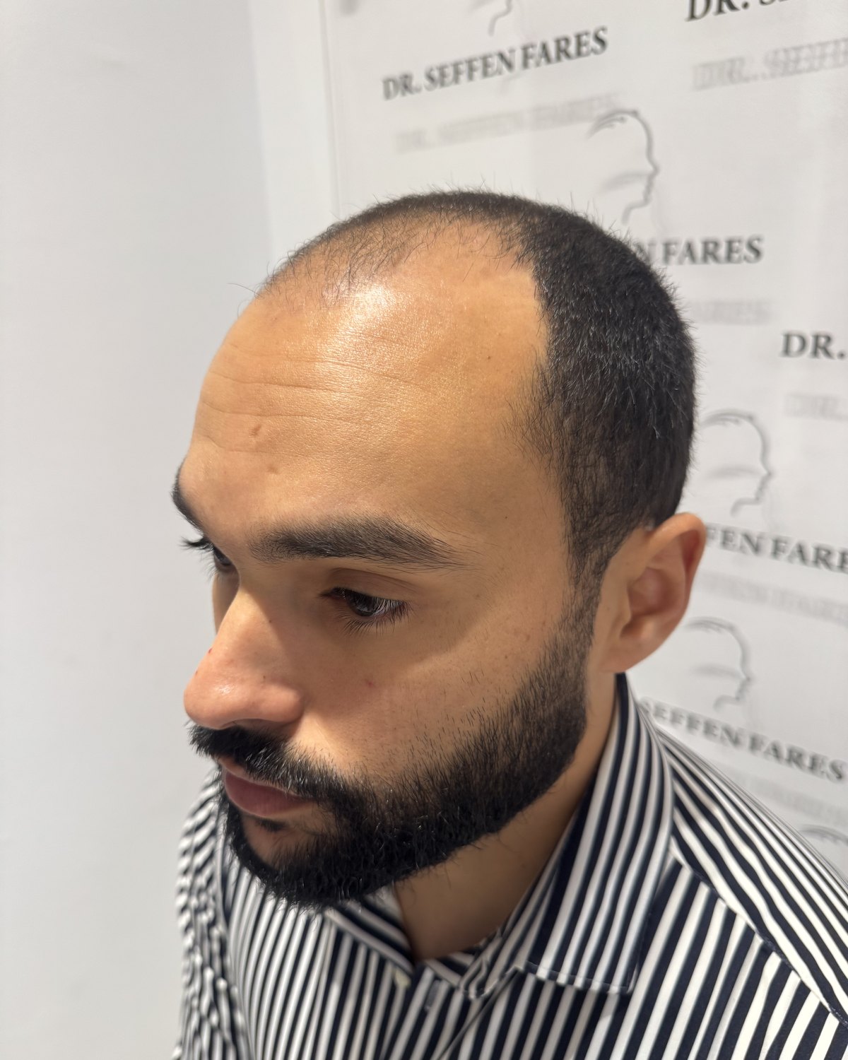 Patient 97 avant la greffe de cheveux, ligne frontale