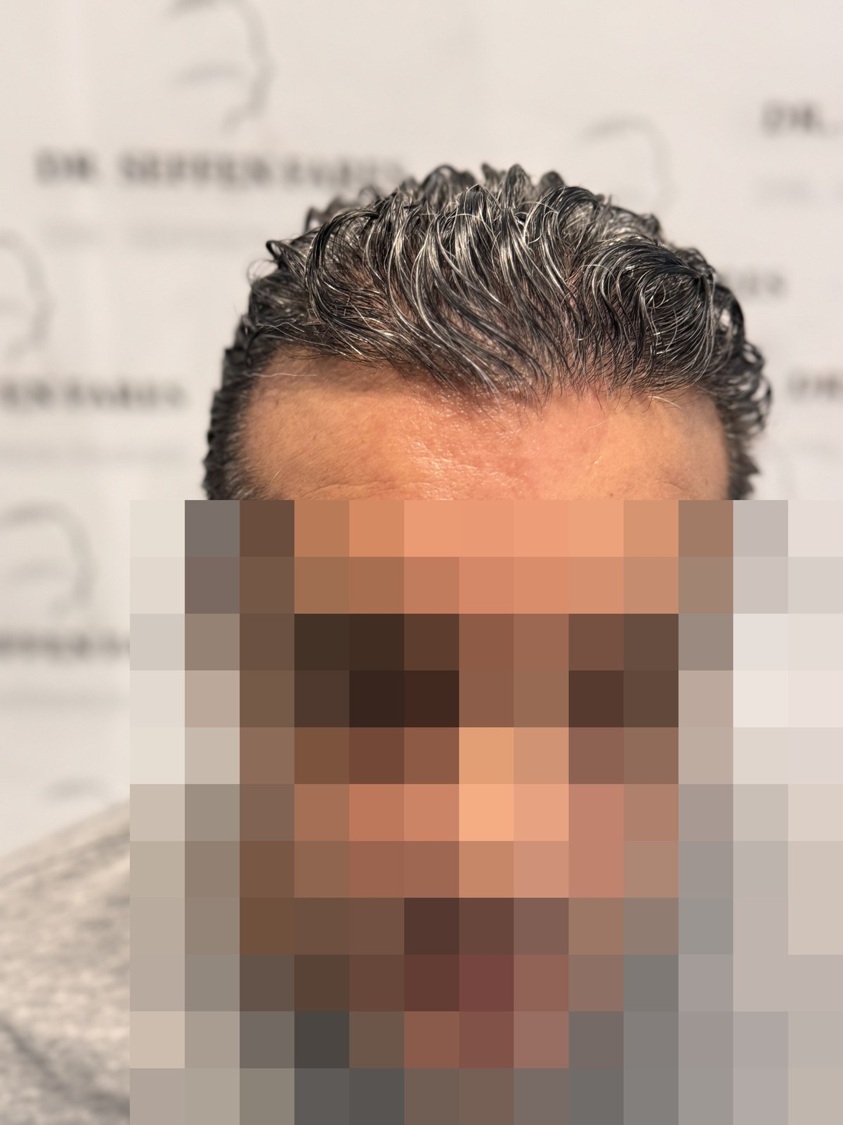 Patient 99 — 2,780 grafts · Norwood 3 · age 45, after hair transplant