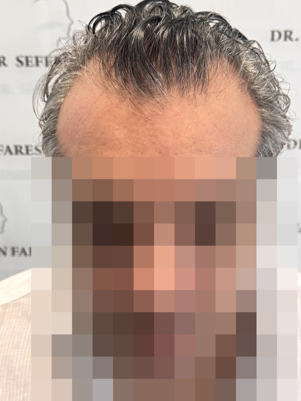 Patient 99 — 2,780 grafts · Norwood 3 · age 45, before hair transplant