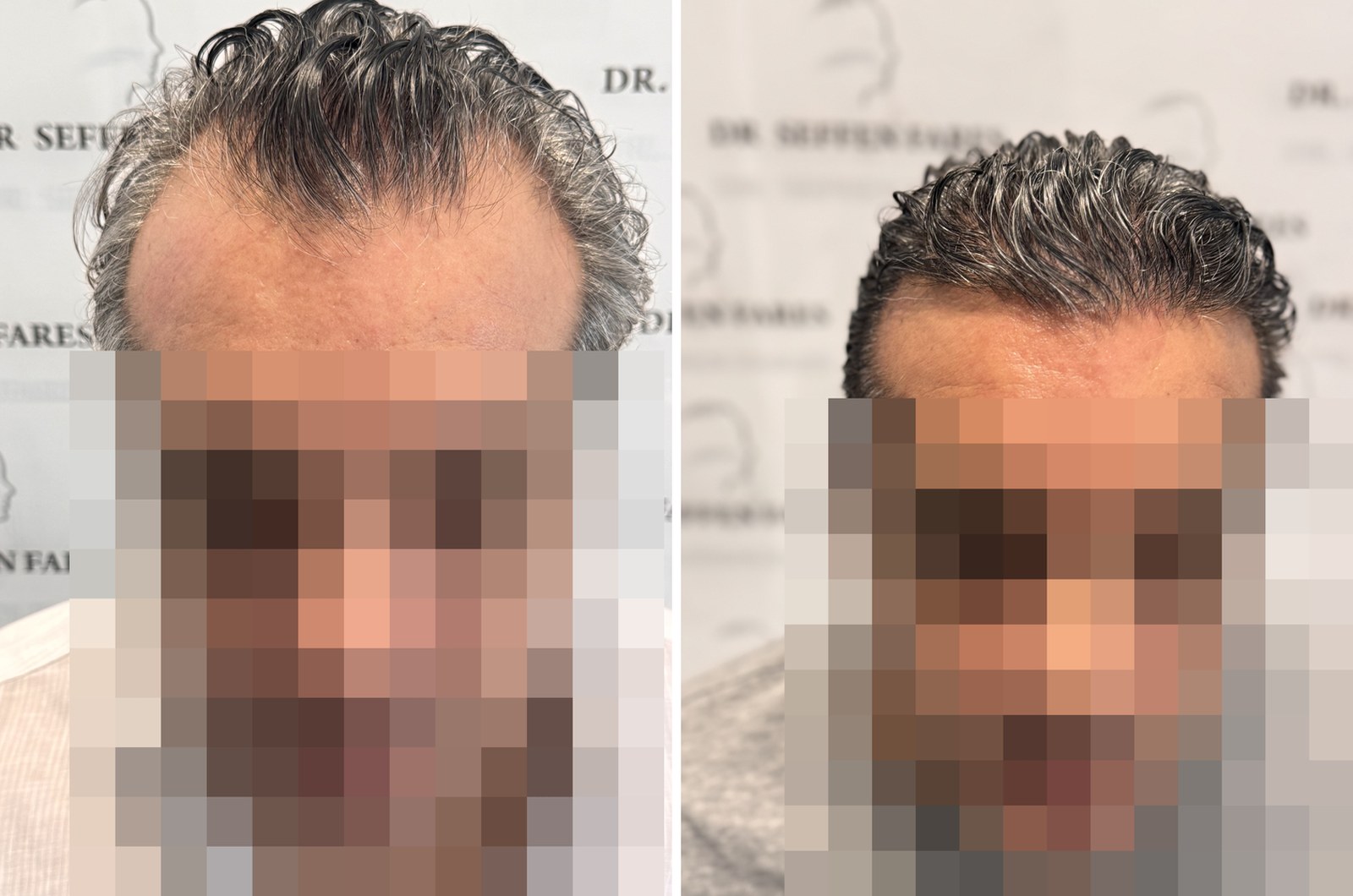 Patient 99, before and after hair transplant, view 1