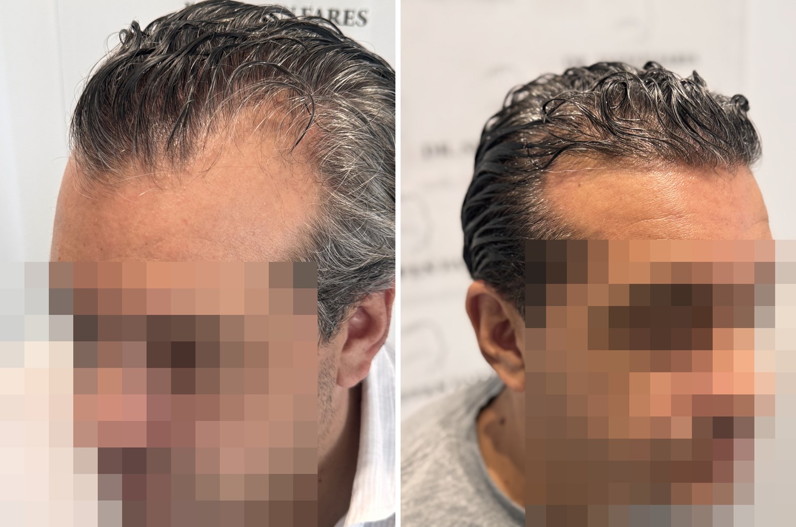 Patient 99, before and after hair transplant, view 2