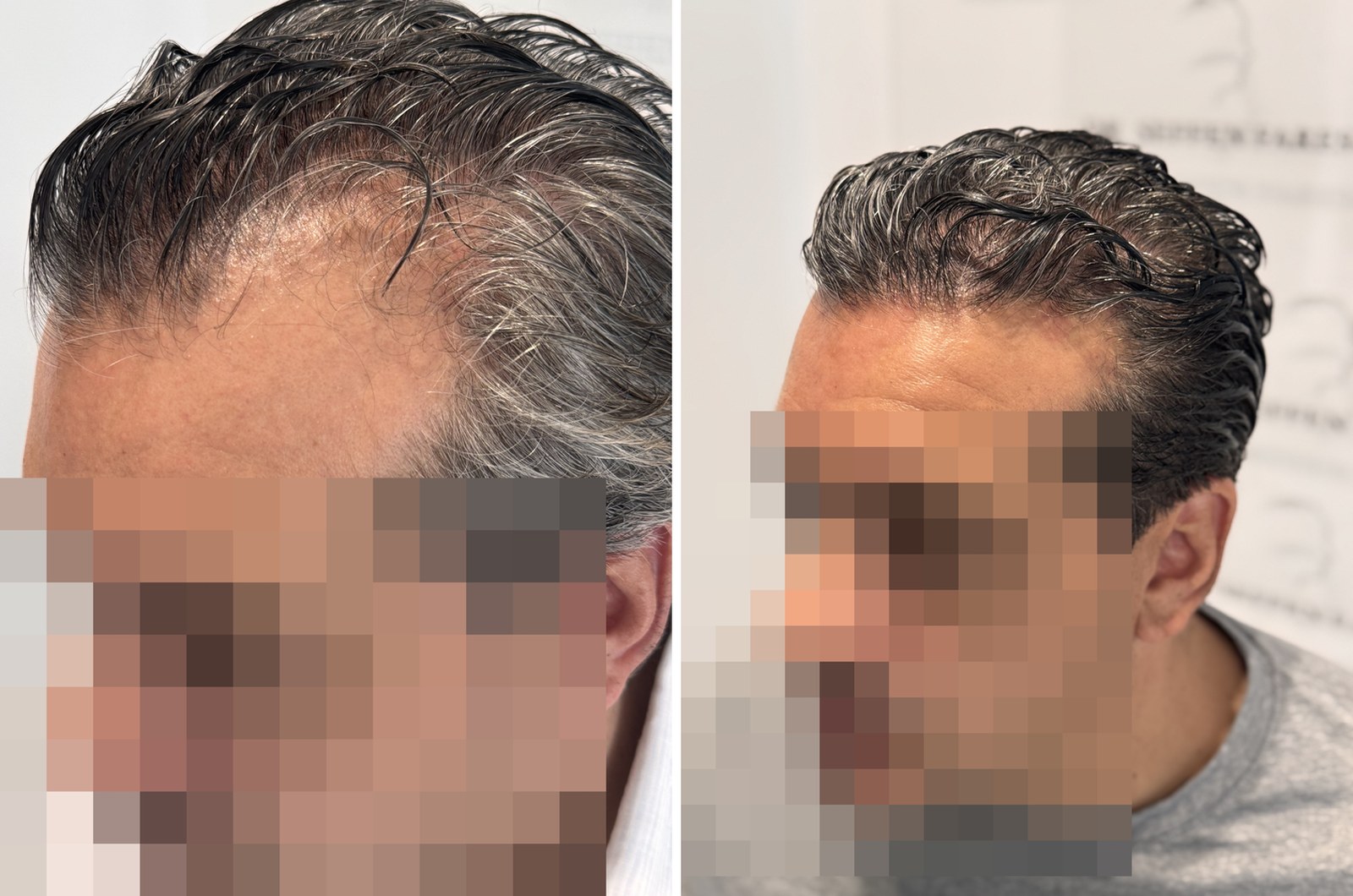 Patient 99, before and after hair transplant, view 3