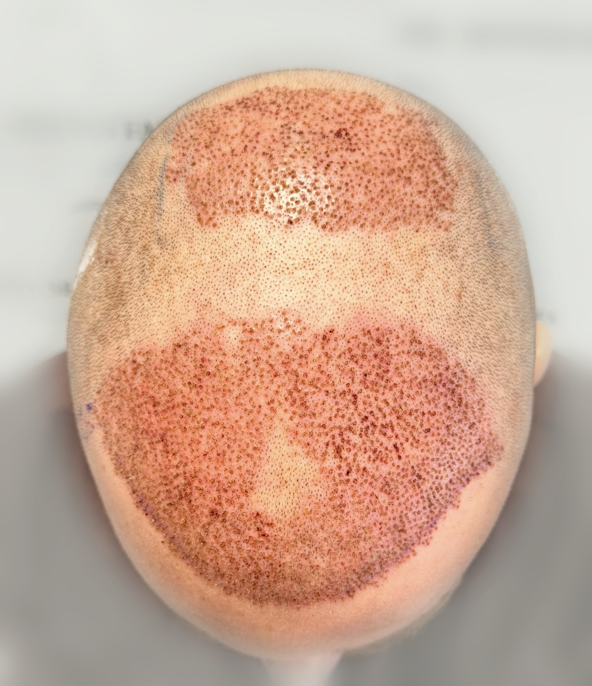 Scalp at the end of the procedure, seen from above, grafts implanted