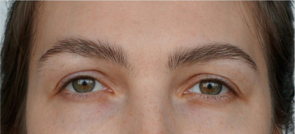 Après greffe de sourcils