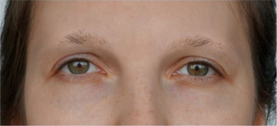 Avant greffe de sourcils