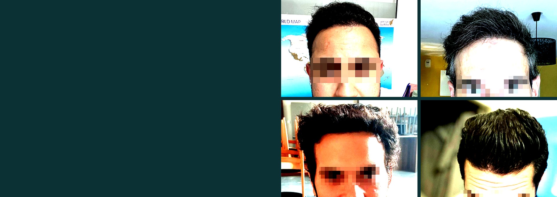 Patients of Dr Seffen's hair transplant clinic in Tunis