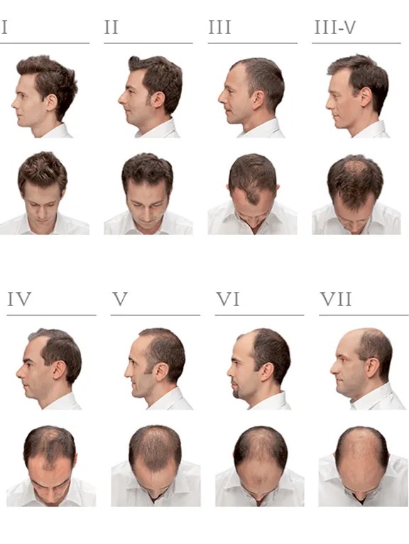 Hamilton-Norwood scale