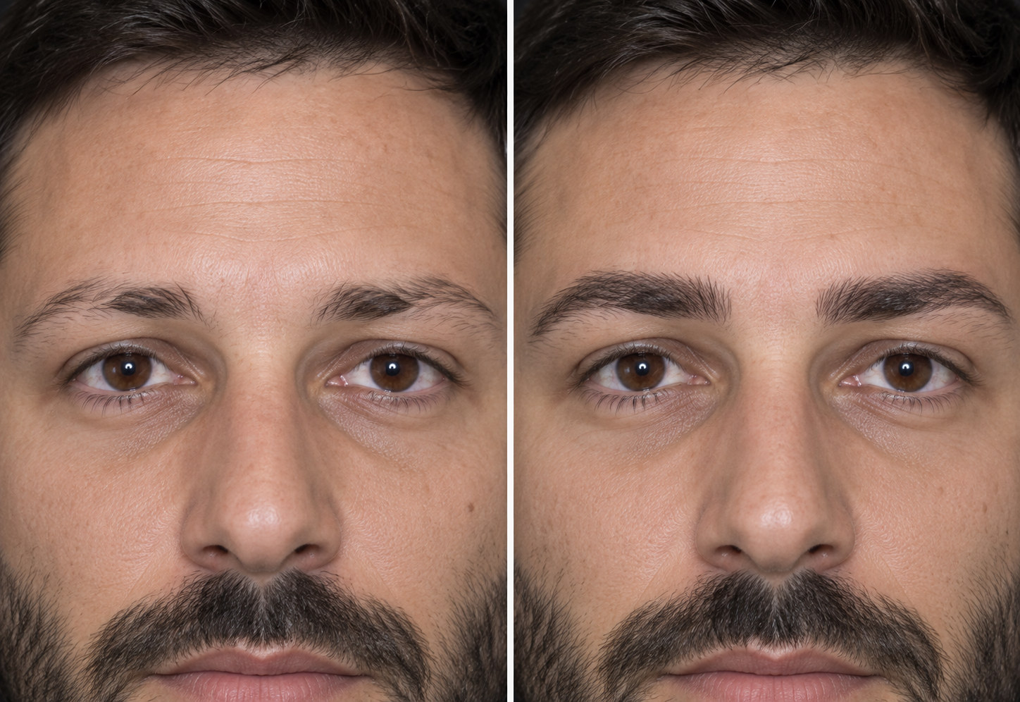 Illustration générée d'une greffe de sourcils chez l'homme, avant et après