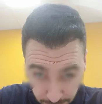 Patient 1, après greffe de cheveux