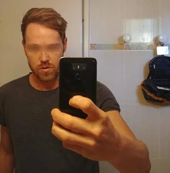 Patient 2, après greffe de cheveux
