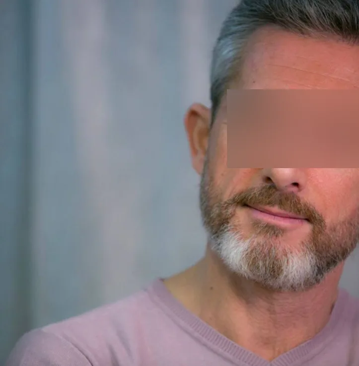 Patient 3, after hair transplant