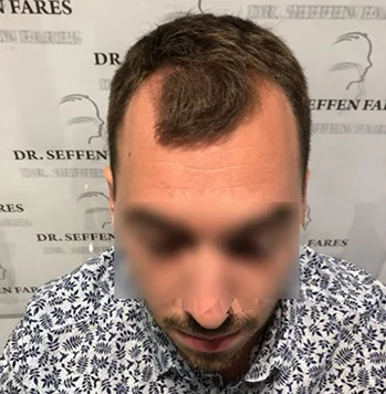Patient 1, avant greffe de cheveux