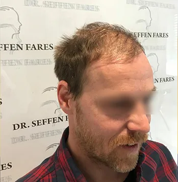 Patient 2, avant greffe de cheveux