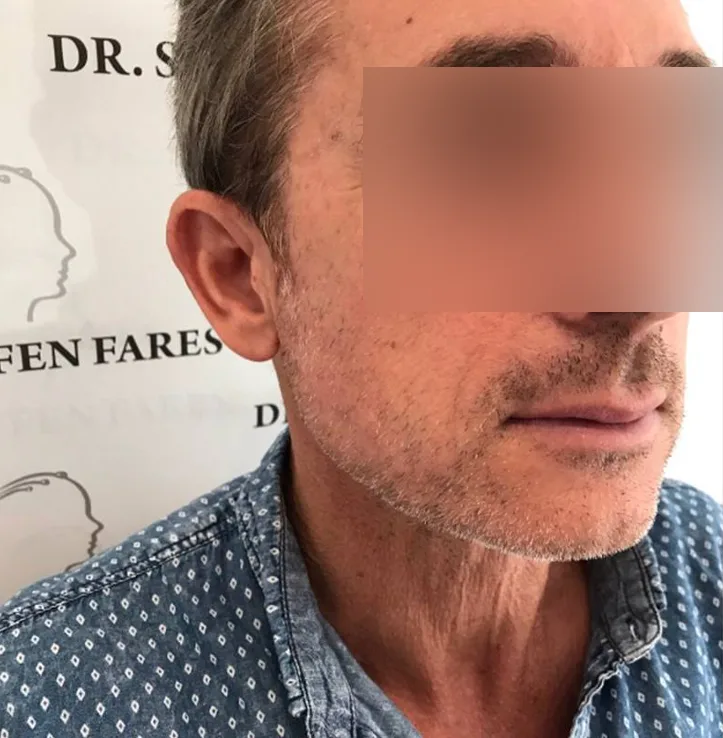 Patient 3, avant greffe de cheveux