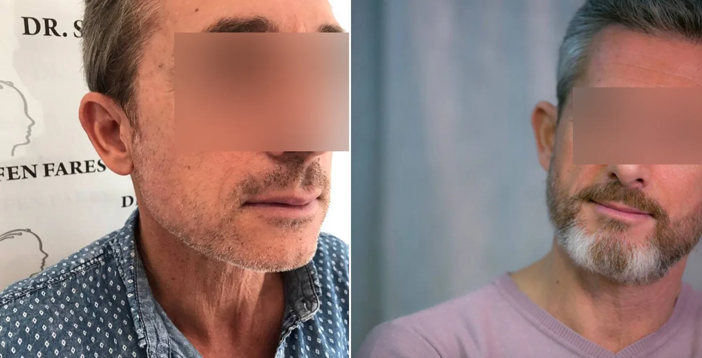 Patient 3, before and after hair transplant, view 1