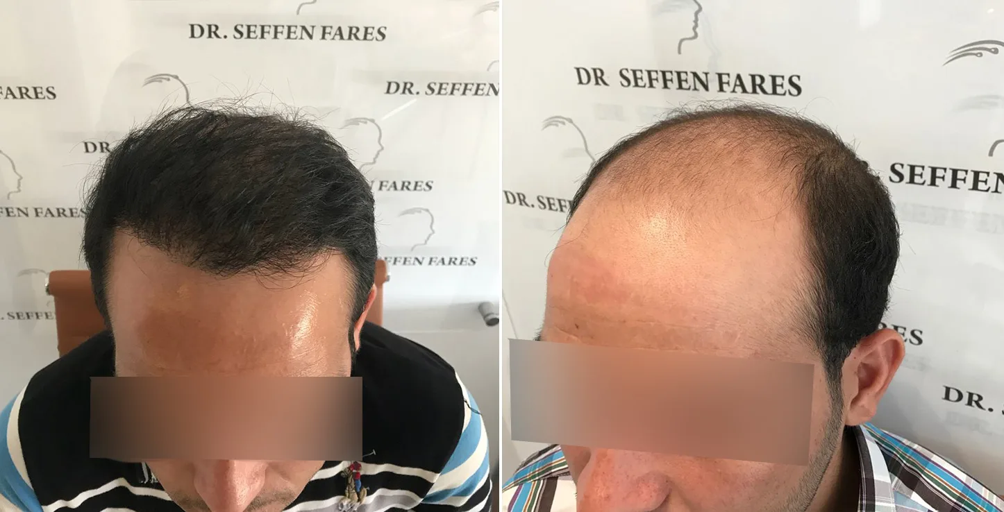 Patient 4, before and after hair transplant, view 1