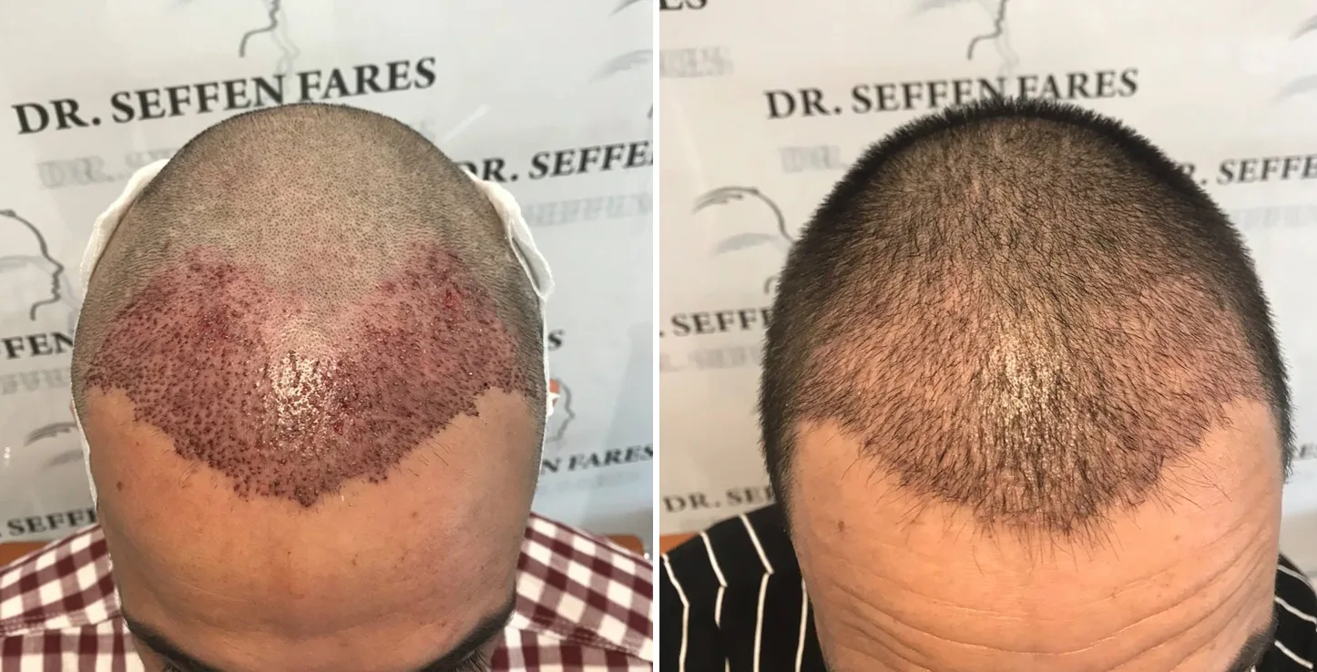Patient 9, before and after hair transplant, view 1