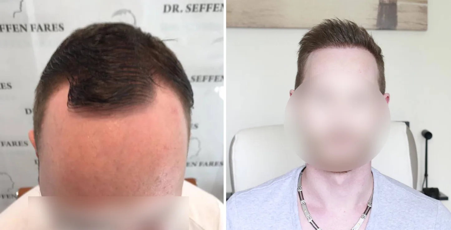 Patient 6, avant et après greffe de cheveux, vue 1