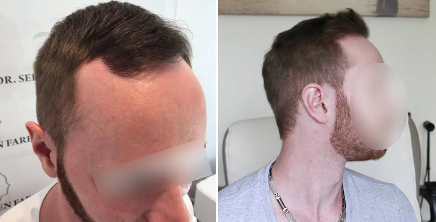 Patient 6, avant et après greffe de cheveux, vue 2