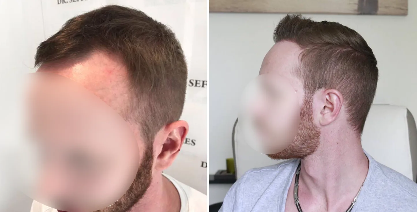 Patient 6, before and after hair transplant, view 3