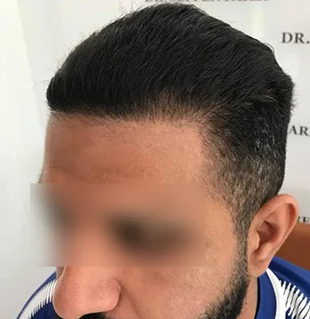 Patient 5, après greffe de cheveux