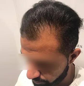 Patient 5, avant greffe de cheveux