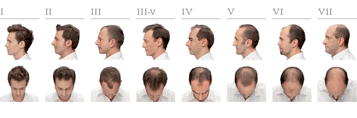 Hamilton-Norwood scale