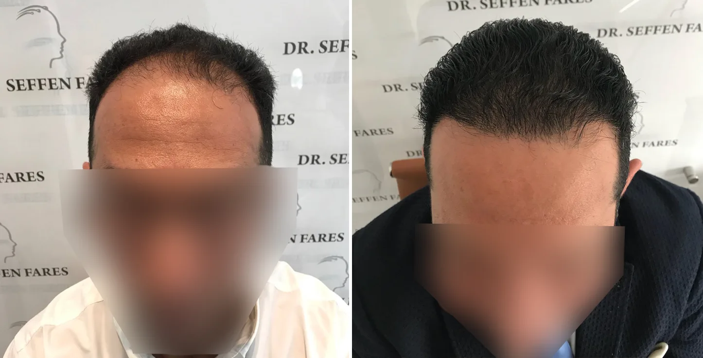 Patient 9, before and after hair transplant, view 2