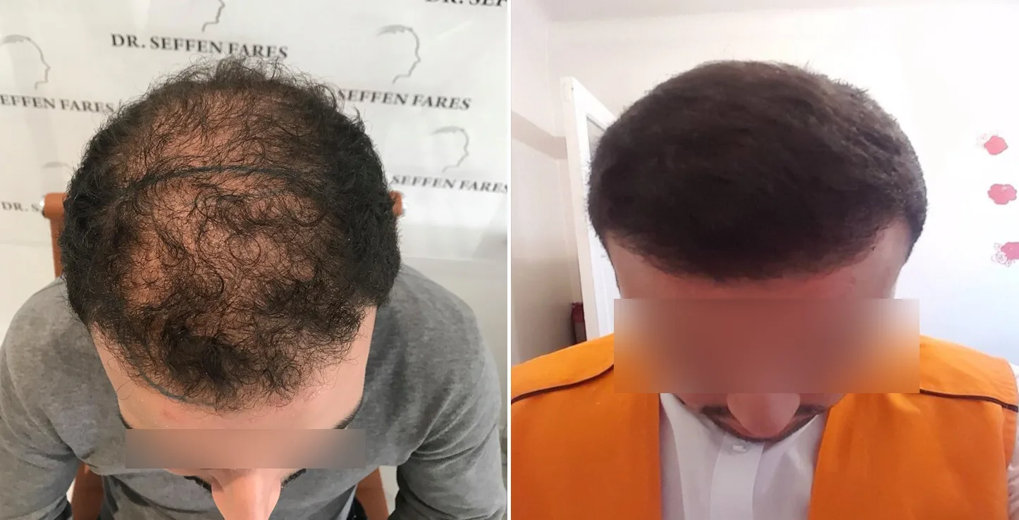 Patient 15, before and after hair transplant, view 2