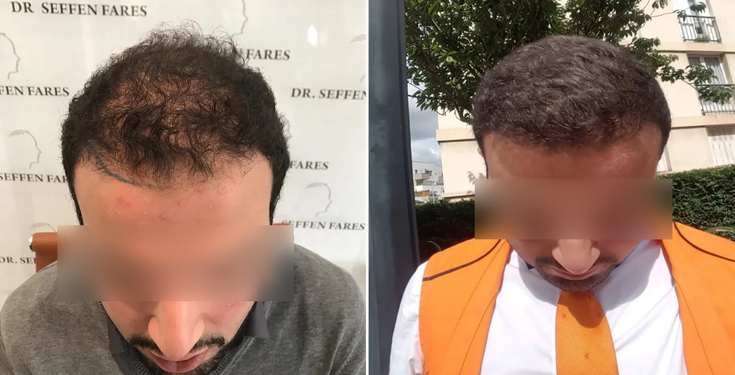 Patient 15, before and after hair transplant, view 1