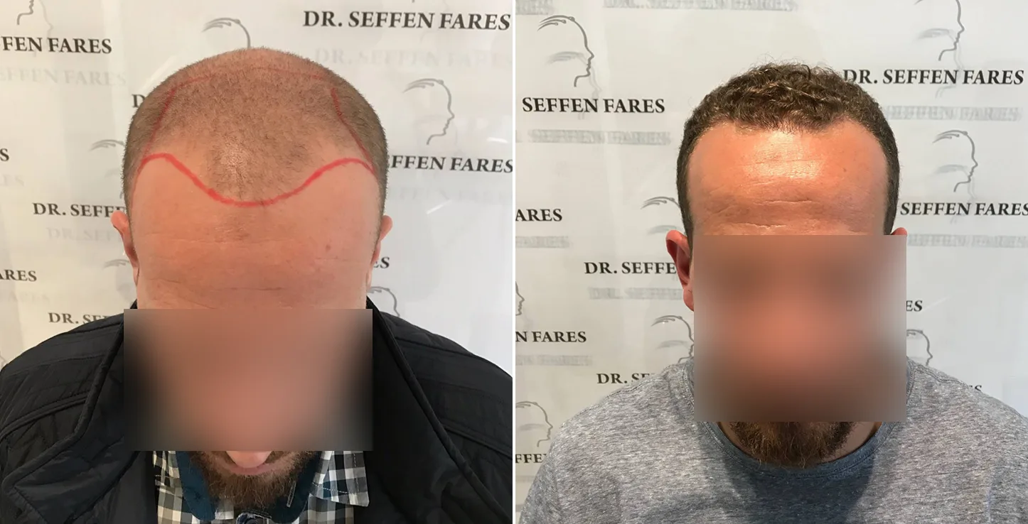 Patient 16, before and after hair transplant, view 2