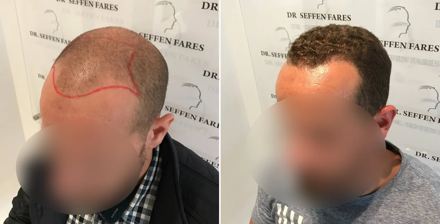 Patient 16, before and after hair transplant, view 1