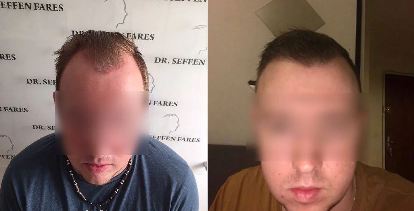 Patient 17, before and after hair transplant, view 2