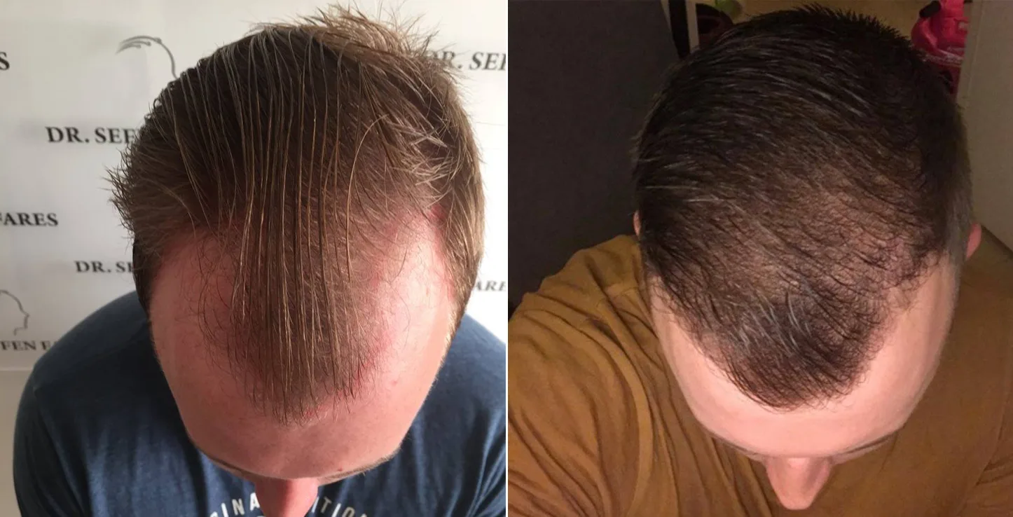 Patient 17, before and after hair transplant, view 1