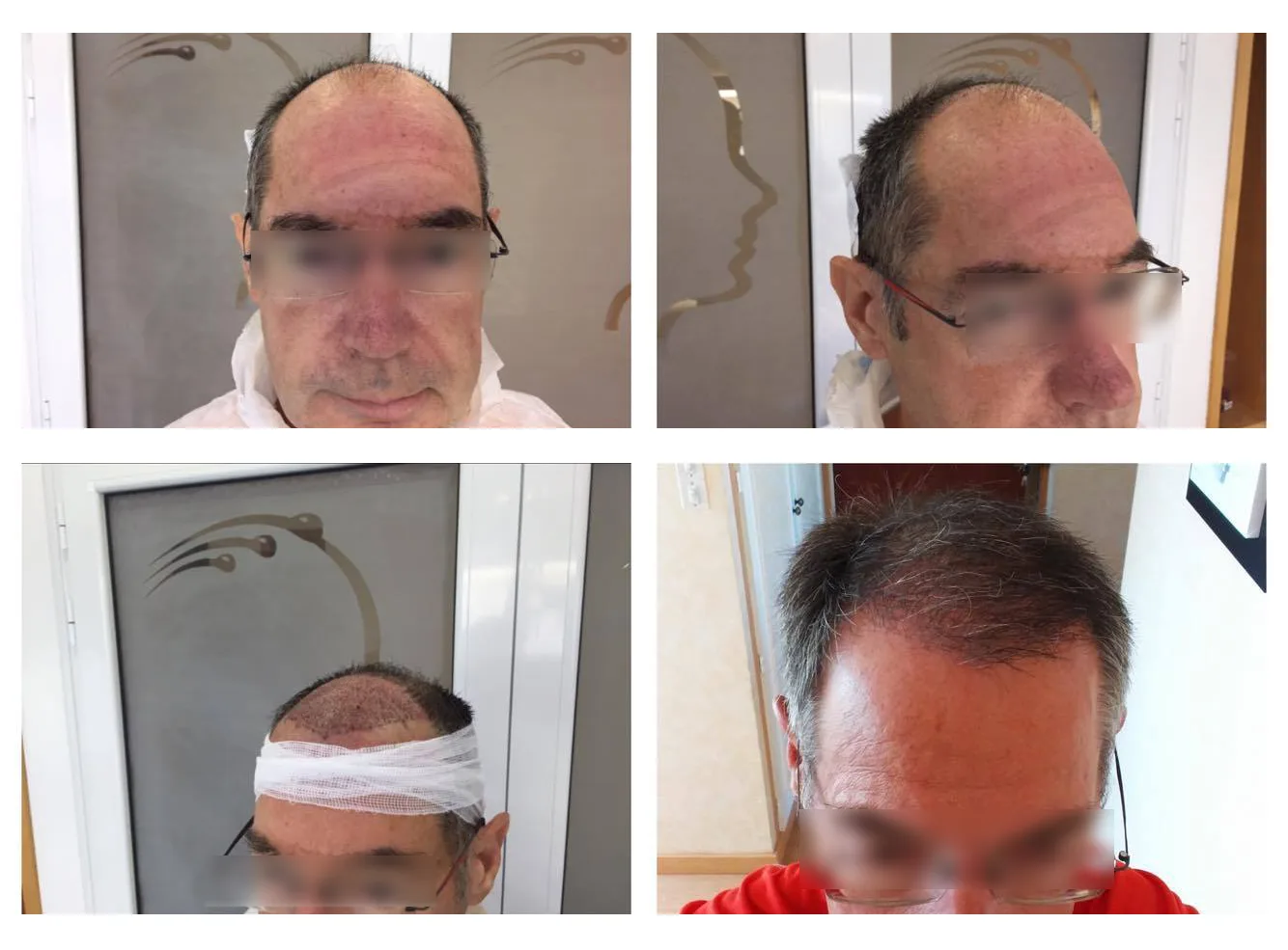 Patient 19, before and after hair transplant, view 1