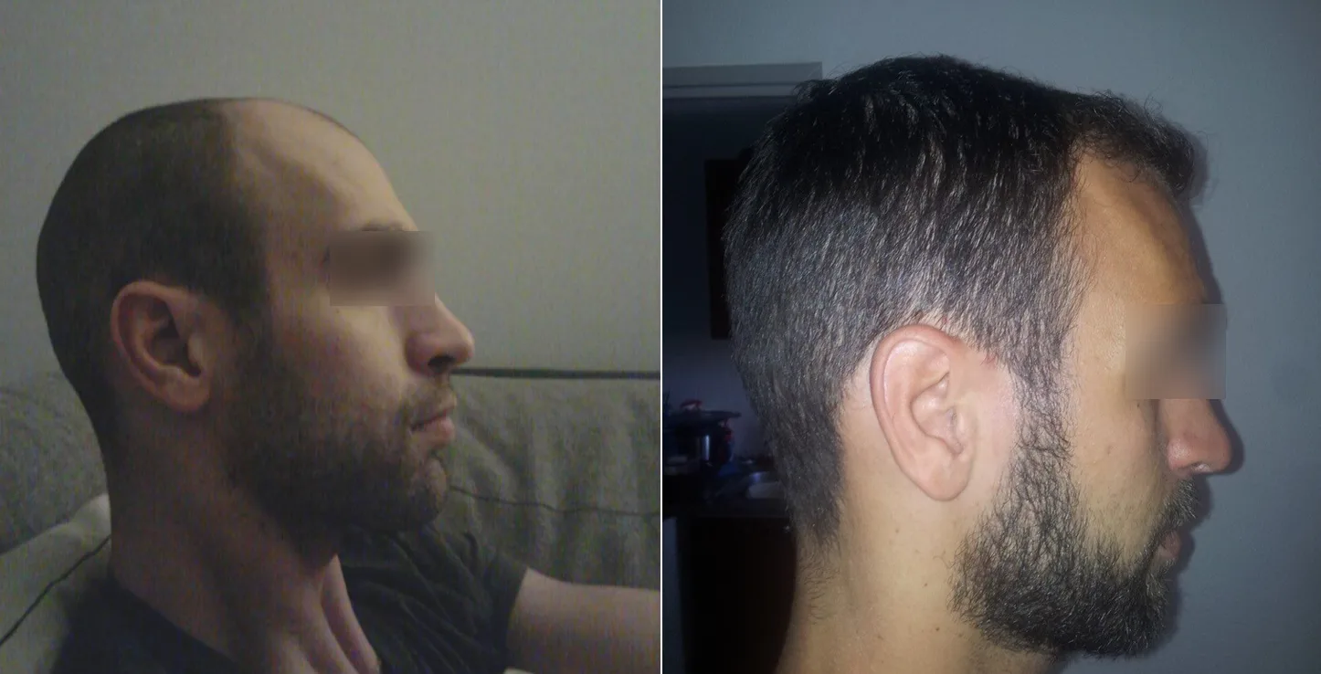 Patient 22, before and after hair transplant, view 1