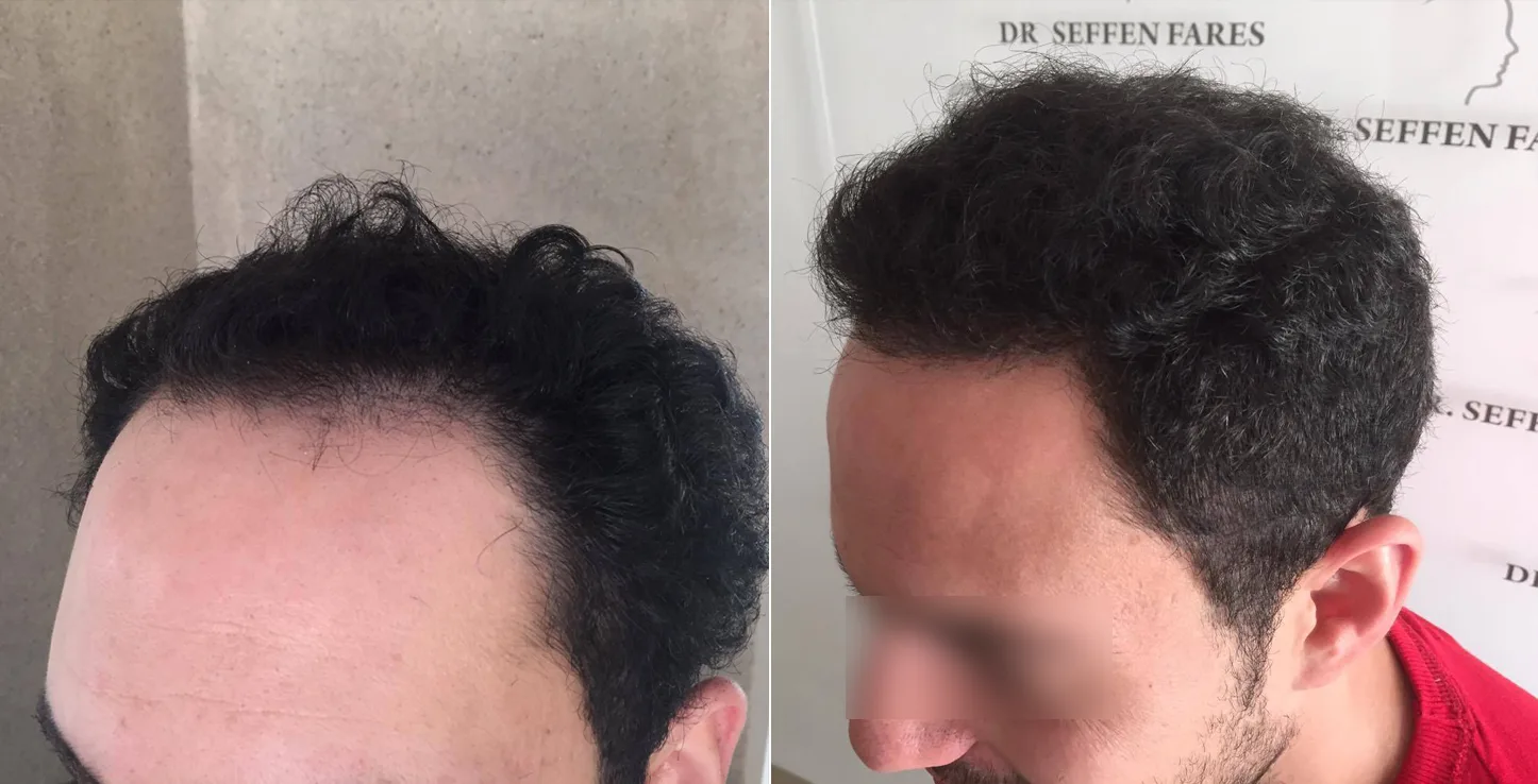 Patient 23, before and after hair transplant, view 2